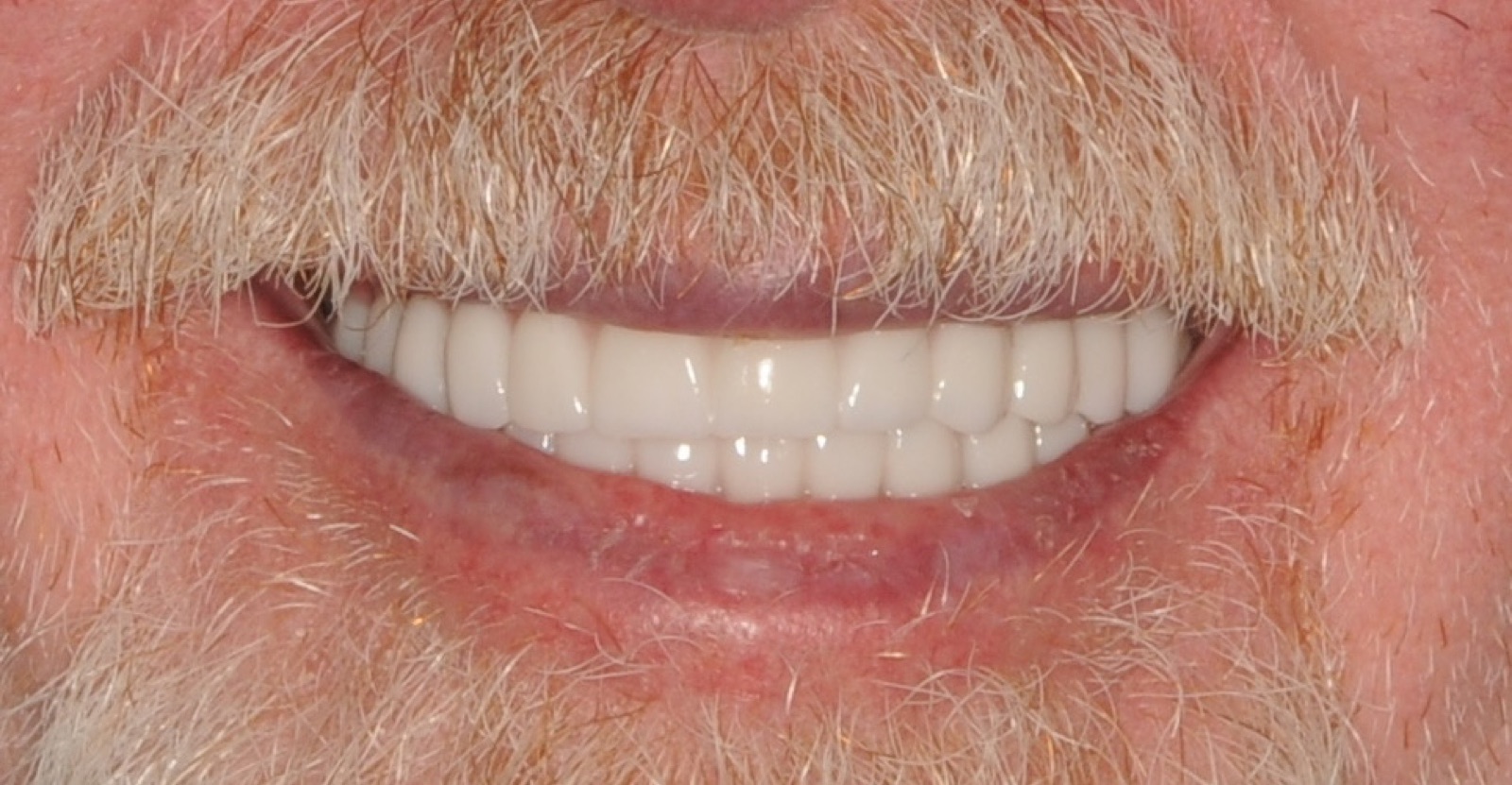 After: full-arch fixed bridge, white and even, framed by the same mustache and beard