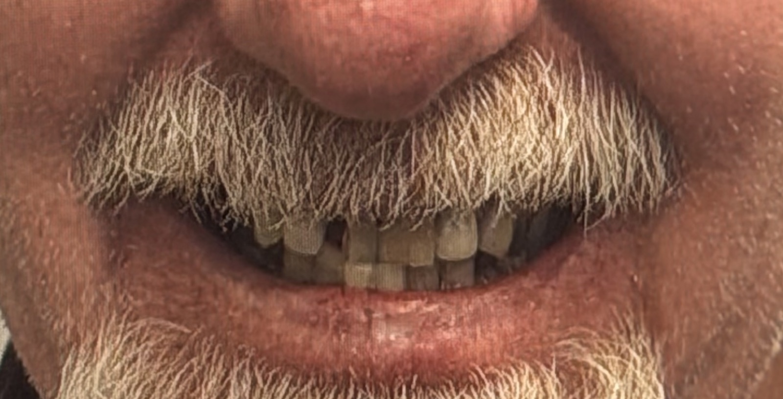 Before: worn, discolored natural teeth seen between a grey mustache and beard