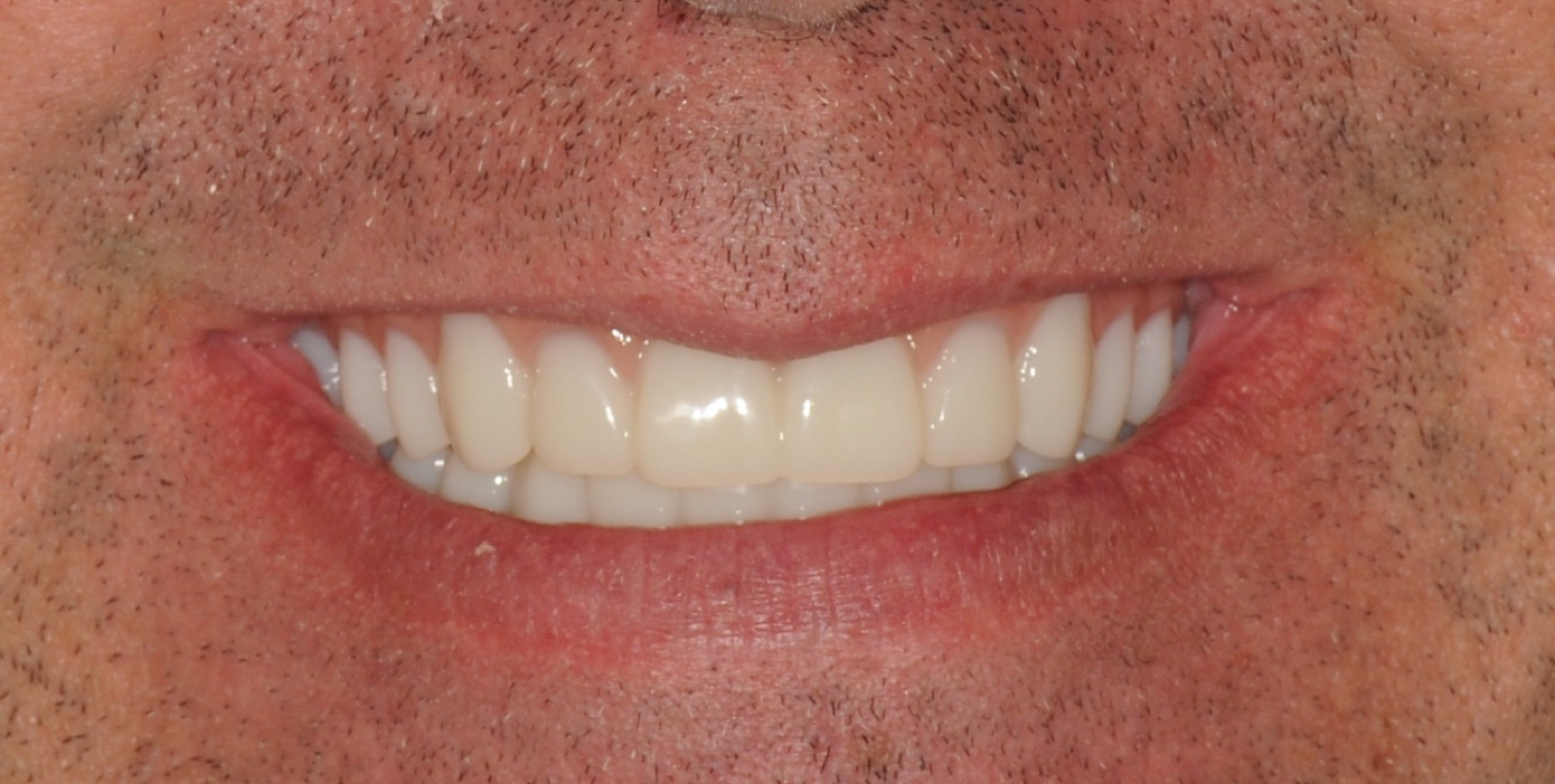 After: full-arch fixed bridge in a natural smile with light stubble