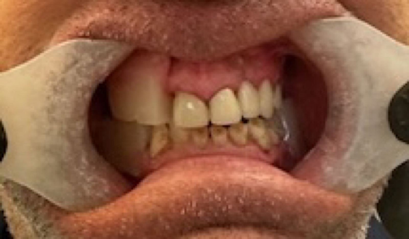 Before: retracted view of misaligned and worn upper and lower teeth