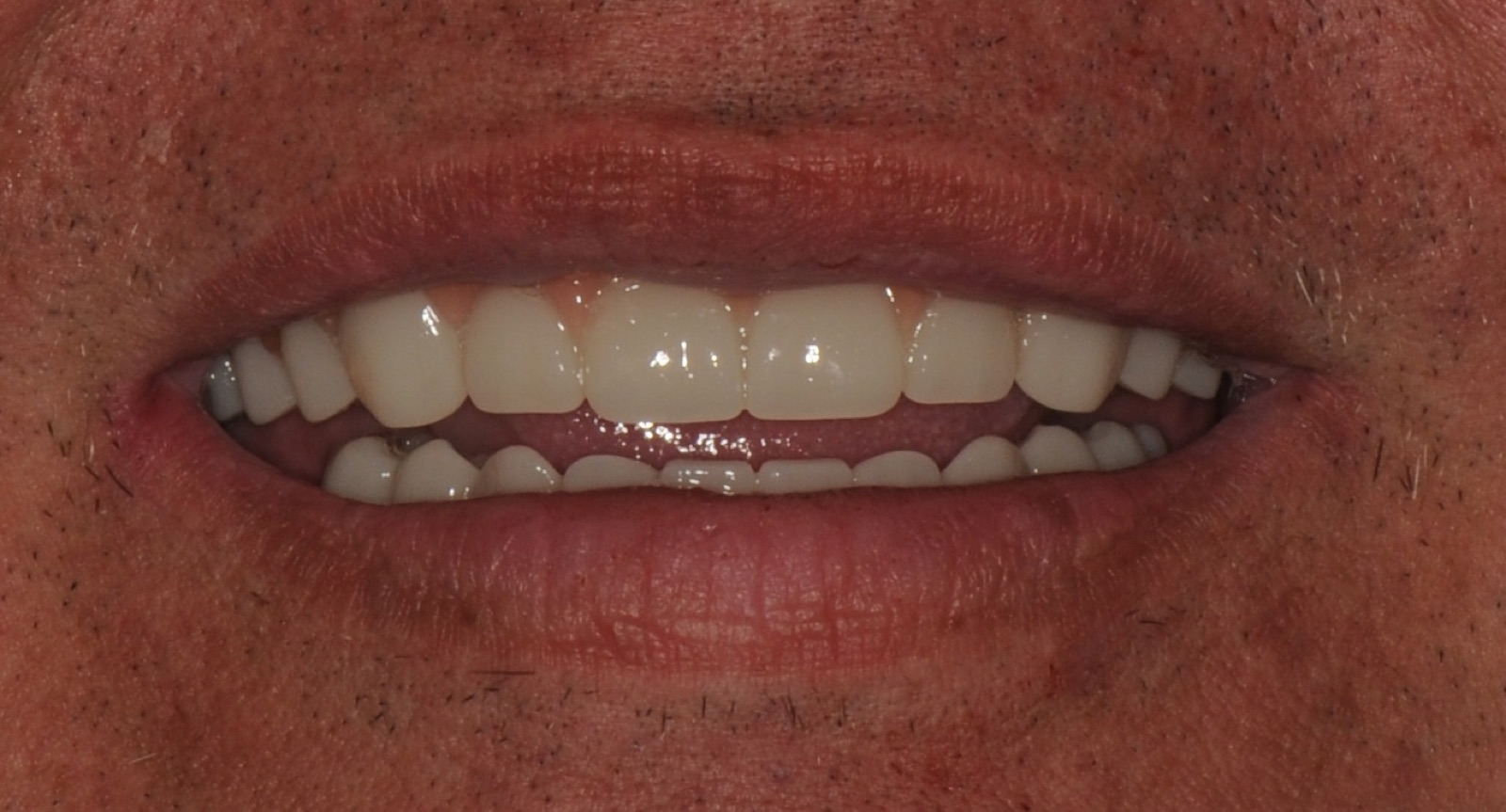 After: full-arch fixed bridge in a natural, relaxed smile