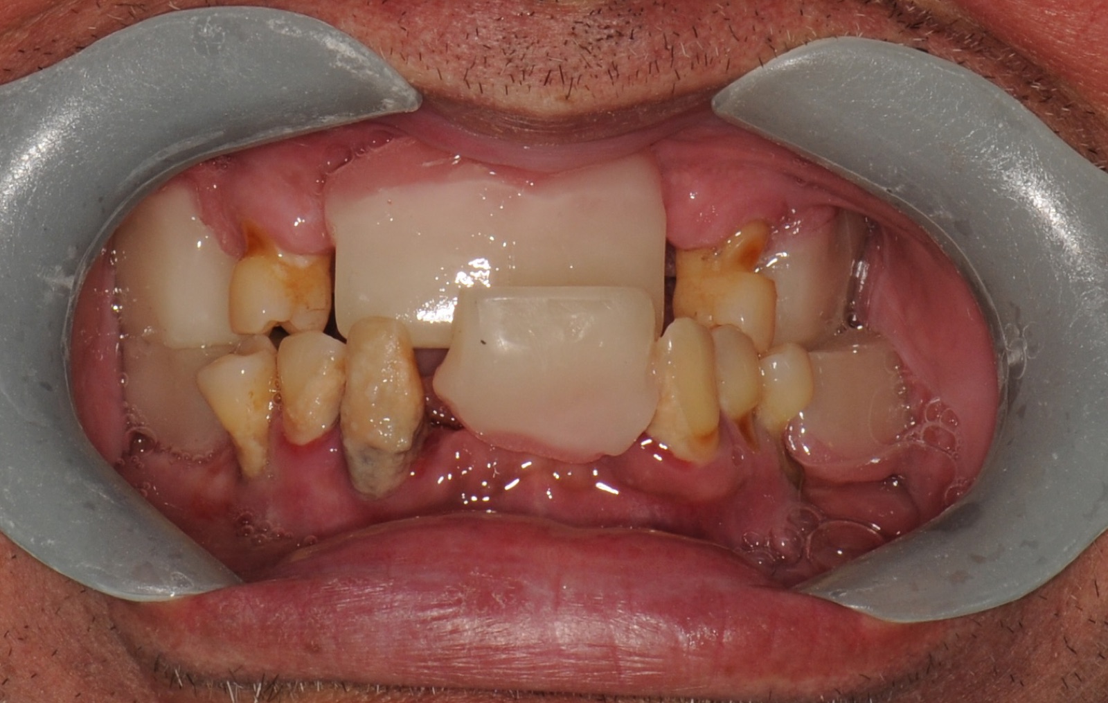 Before: retracted view of failing teeth, missing teeth and an old crown